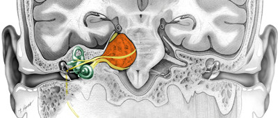 pe-acoustic-neuroma-sm_副本.jpg